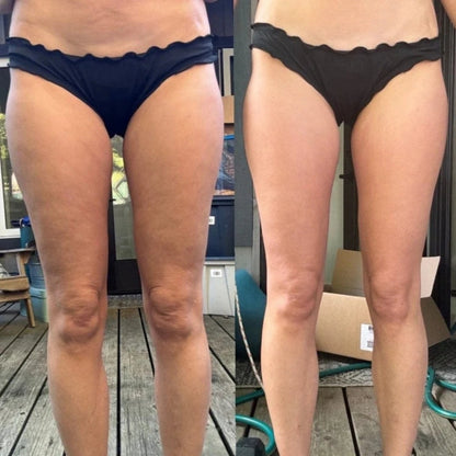 BodyRevive™ - Cellulite Massager